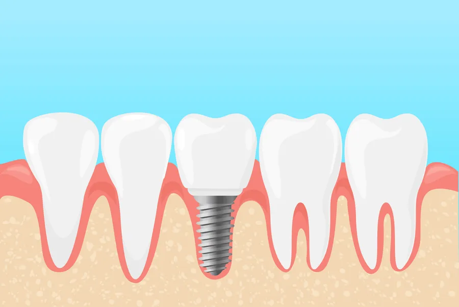 A Journey to a Beautiful Smile: Dental Implants and Veneers